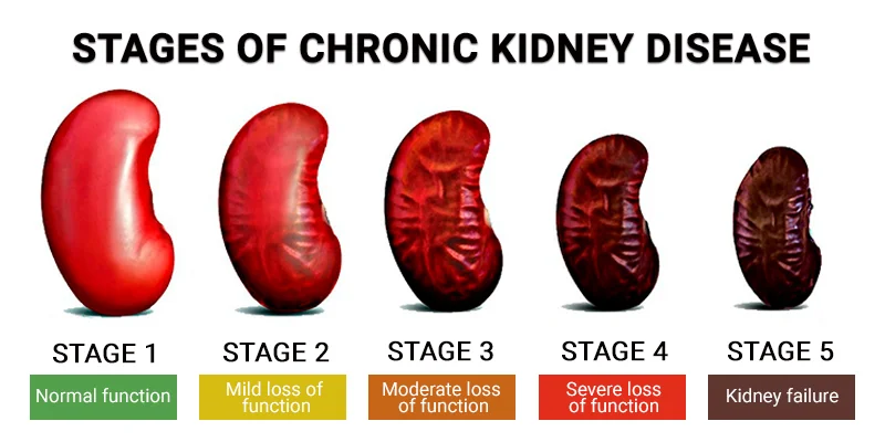 stages-of-chronic-kidney-disease.jpg